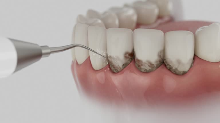Trusted Dental Crowns And Bridges service in Breckenridge Hills, MO - Dentist Open Now